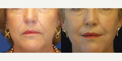 Lip Lift before and after photo