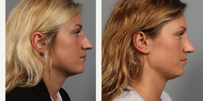 Rhinoplasty before and after photo