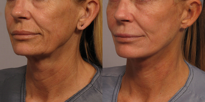Facelift before and after photo