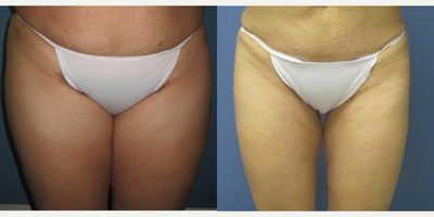 Liposuction before and after photo