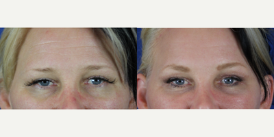 Brow Lift before and after photo