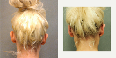 Ear Surgery before and after photo