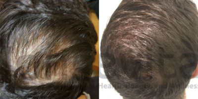PRP for Hair Loss before and after photo