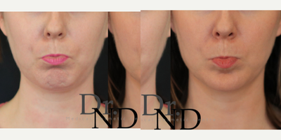Botox for Gummy Smile before and after photo