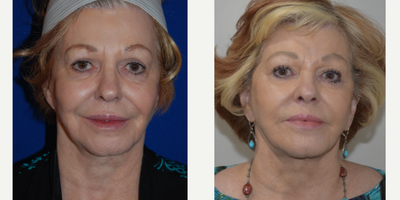 Brow Lift before and after photo