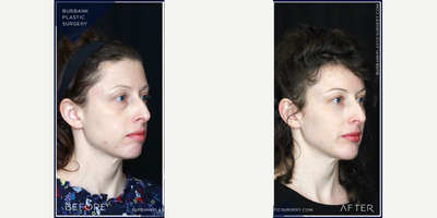 Chin Implant before and after photo