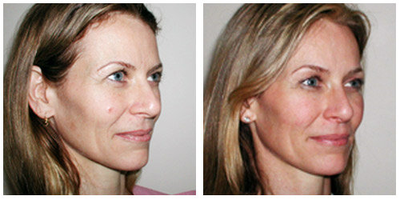 Eyelid Surgery before and after photo