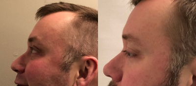 Juvederm before and after photo