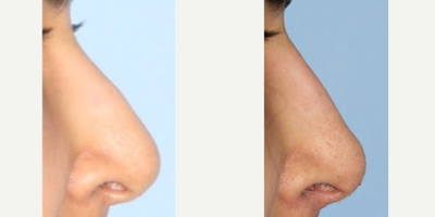 Nonsurgical Nose Job before and after photo