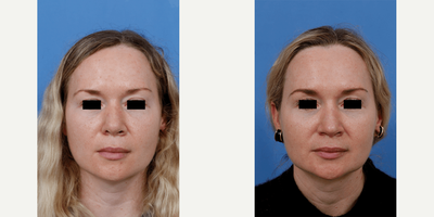 Revision Rhinoplasty before and after photo