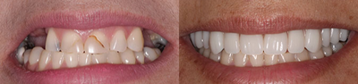 All-on-4 Dental Implants before and after photo