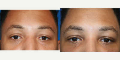 Eyelid Surgery before and after photo