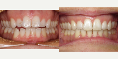 Invisalign before and after photo
