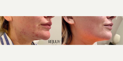 Microneedling before and after photo