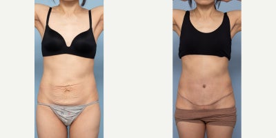 Tummy Tuck before and after photo