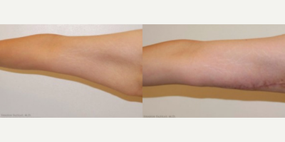 Arm Lift before and after photo