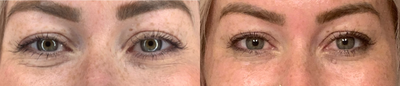Botox before and after photo