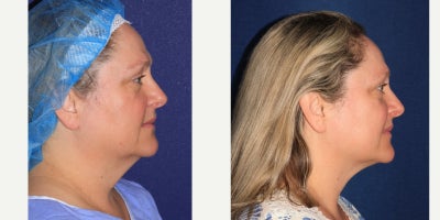 Chin Liposuction before and after photo