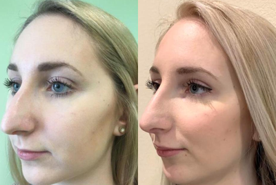 Dermal Fillers before and after photo