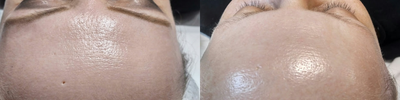 Microneedling before and after photo