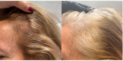 PRP for Hair Loss before and after photo