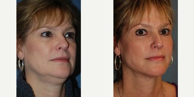 Chin Liposuction before and after photo
