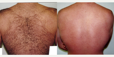 Laser Hair Removal before and after photo