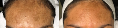 Laser Resurfacing before and after photo