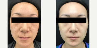 PicoSure before and after photo