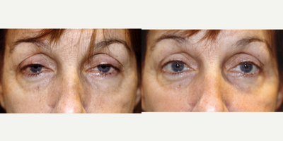 Ptosis Surgery before and after photo