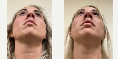 Rhinoplasty before and after photo