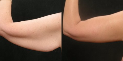 Arm Lift before and after photo