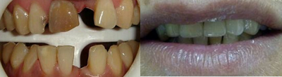 Dental Implants before and after photo