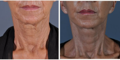 Facelift before and after photo