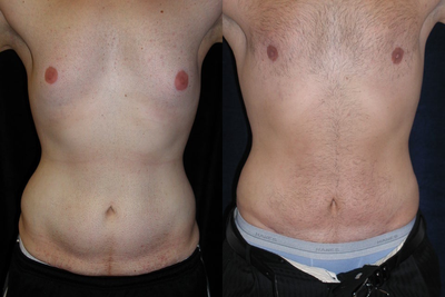 Male Tummy Tuck before and after photo