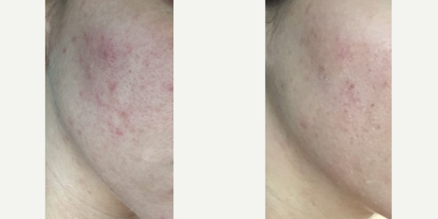 Microneedling before and after photo