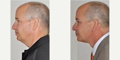 Neck Lift before and after photo