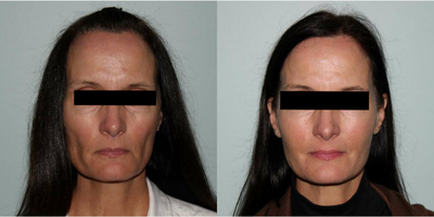 Sculptra before and after photo