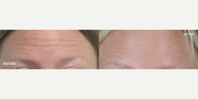 Botox before and after photo