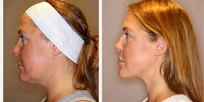 Laser Liposuction before and after photo