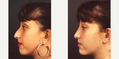 Rhinoplasty before and after photo