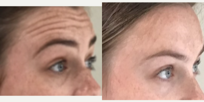 Botox before and after photo