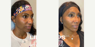 Cheek Fillers before and after photo