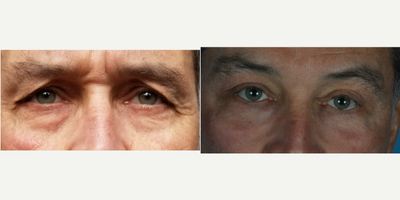 Eyelid Surgery before and after photo