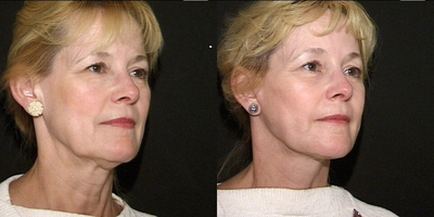 Facelift before and after photo