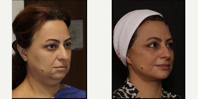 Facelift before and after photo