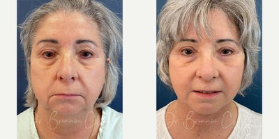 Neck Lift before and after photo