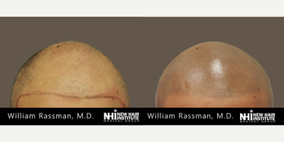 Scalp Micropigmentation before and after photo