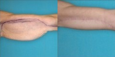 Arm Lift before and after photo