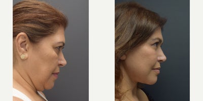 Facelift before and after photo